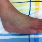 Wabah Chikungunya