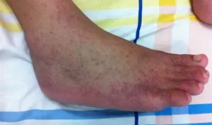 Wabah Chikungunya Wabah Chikungunya