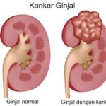 kanker ginjal